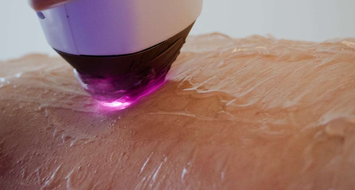 Laser Hair Reduction