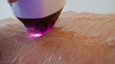 Laser Hair Reduction